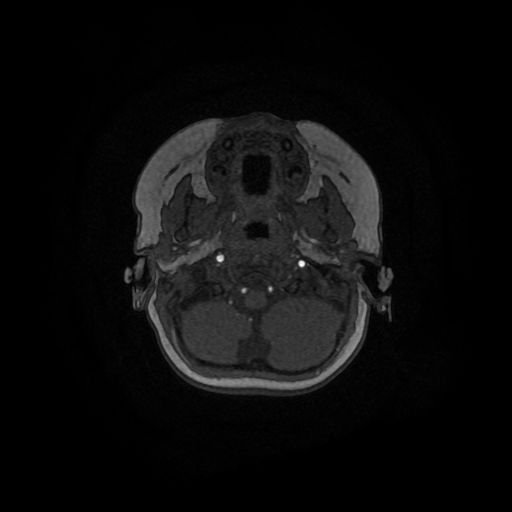 Acute phase of hemiconvulsion-hemiplegia epilepsy syndrome (Radiopaedia 29309-29745 Axial TOF angiography 143).jpg