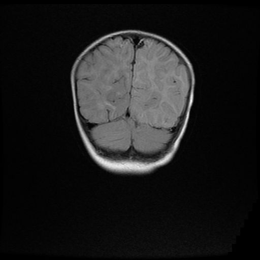 File:Acute phase of hemiconvulsion-hemiplegia epilepsy syndrome (Radiopaedia 29309-29745 Coronal FLAIR 19).jpg