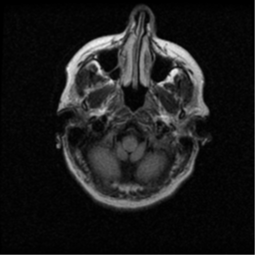 File:Acute pontine infarct from vertebral artery dissection (Radiopaedia 34111-35370 Axial FLAIR 2).png