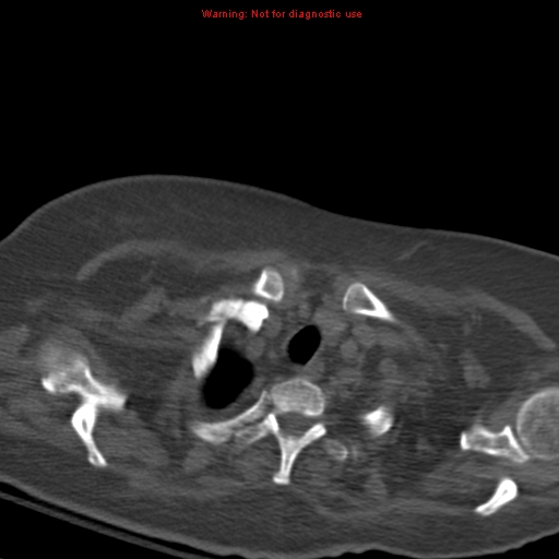 Acute pulmonary embolism (Radiopaedia 13286-13289 Axial C+ CTPA 8).jpg