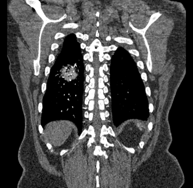 Acute pulmonary embolism with pulmonary infarcts (Radiopaedia 77688-89908 Coronal C+ CTPA 91).jpg
