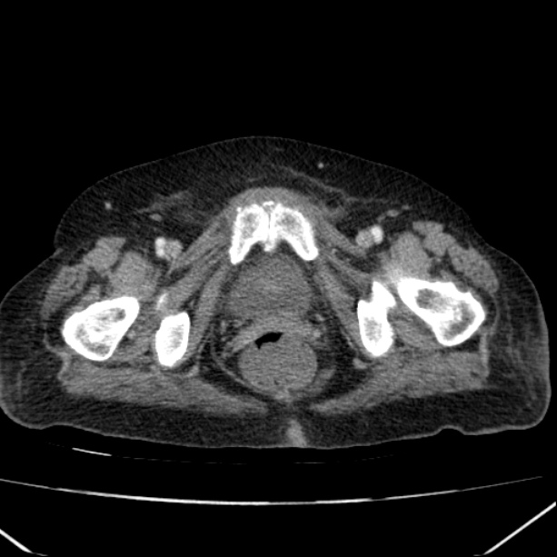 Acute pyelonephritis (Radiopaedia 26584-26729 Axial renal cortical phase 74).jpg