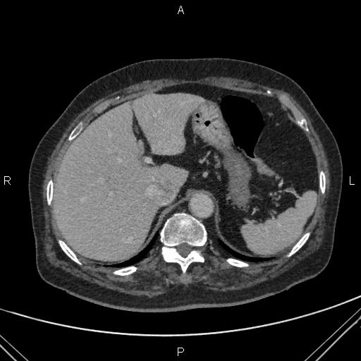 File:Acute renal artery occlusion (Radiopaedia 86586-102682 Axial C+ portal venous phase 12).jpg
