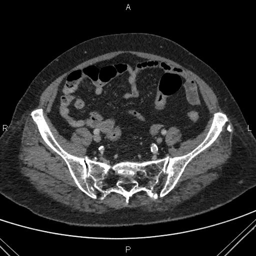 File:Acute renal artery occlusion (Radiopaedia 86586-102682 Axial C+ portal venous phase 75).jpg