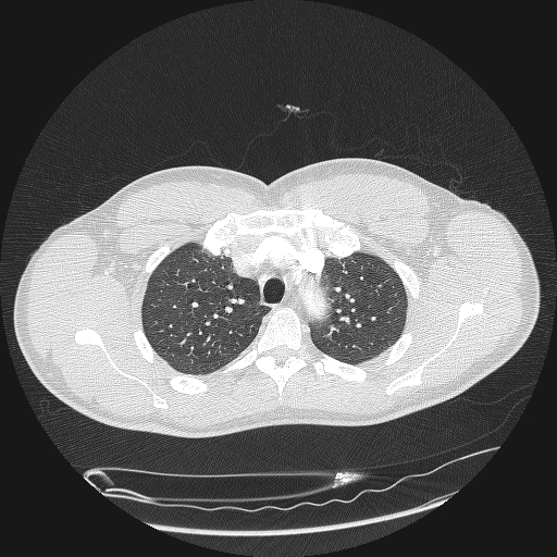 Acute segmental pulmonary emboli and pulmonary infarction (Radiopaedia 62264-70444 Axial lung window 39).jpg