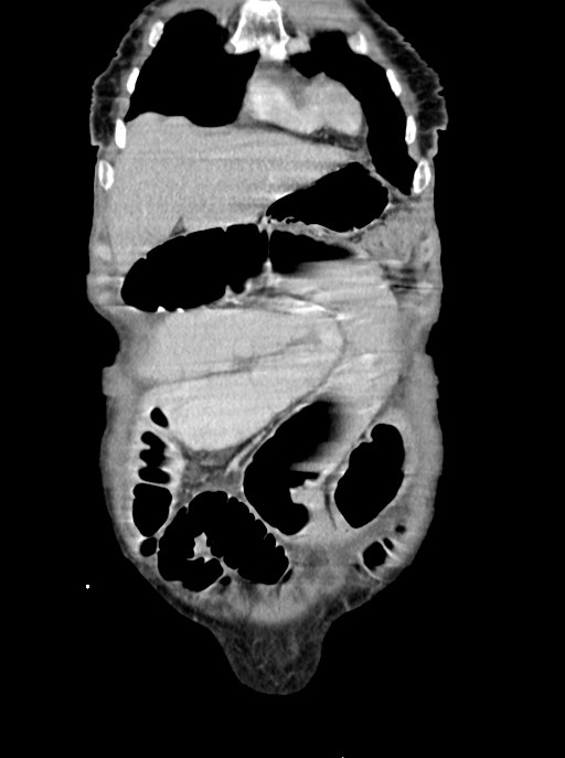Acute small bowel (ileal) volvulus (Radiopaedia 71740-82139 Coronal C+ portal venous phase 21).jpg
