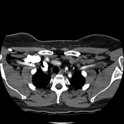 Acute subarachnoid hemorrhage and accessory anterior cerebral artery (Radiopaedia 69231-79009 Axial C+ arterial phase 24).jpg