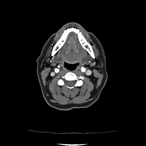 Acute subarachnoid hemorrhage and accessory anterior cerebral artery (Radiopaedia 69231-79009 Axial C+ arterial phase 56).jpg