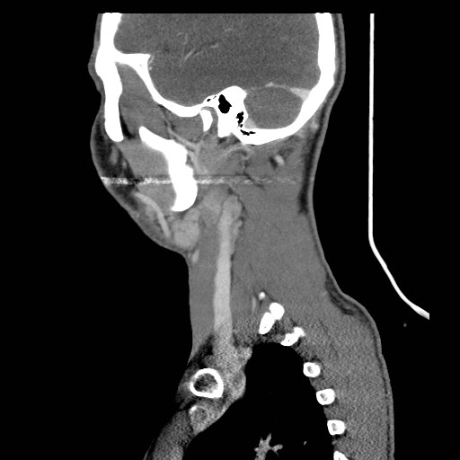 File:Acute submandibular sialadenitis secondary to ductal stone (Radiopaedia 27999-28267 Sagittal C+ delayed 7).jpg