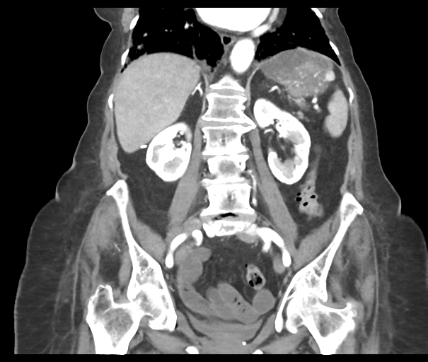 Acute superior mesenteric artery occlusion (Radiopaedia 43926-47418 Coronal C+ portal venous phase 30).png