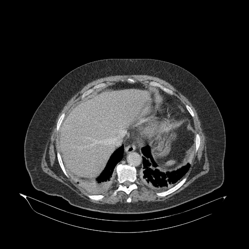 Acute superior mesenteric artery occlusion (Radiopaedia 51288-56960 Axial C+ portal venous phase 12).jpg