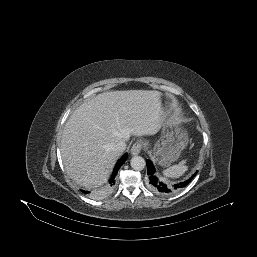 Acute superior mesenteric artery occlusion (Radiopaedia 51288-56960 Axial C+ portal venous phase 14).jpg