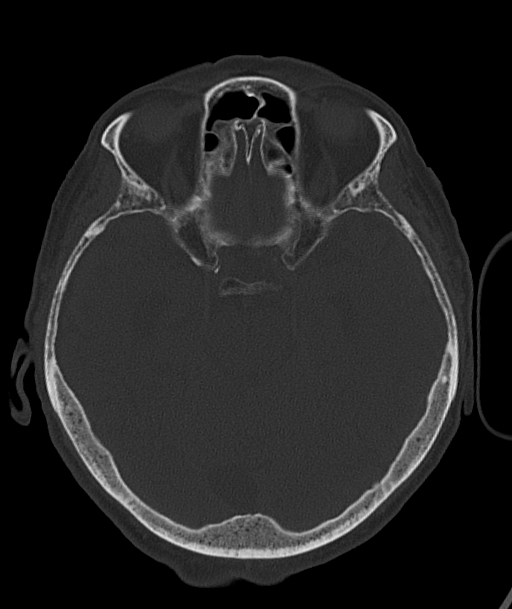 Acute traumatic subdural hematoma (Radiopaedia 82921-97257 Axial bone window 69).jpg