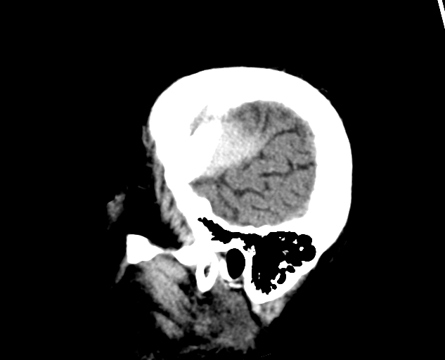 Acute traumatic subdural hematoma (Radiopaedia 82921-97257 Sagittal non-contrast 14).jpg