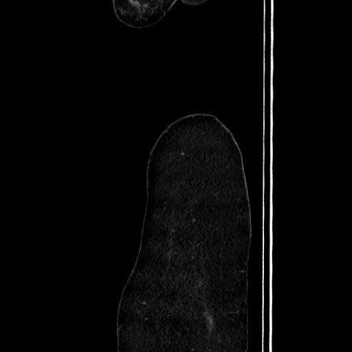 Acute uncomplicated appendicitis (Radiopaedia 73704-84499 Sagittal C+ portal venous phase 25).jpg