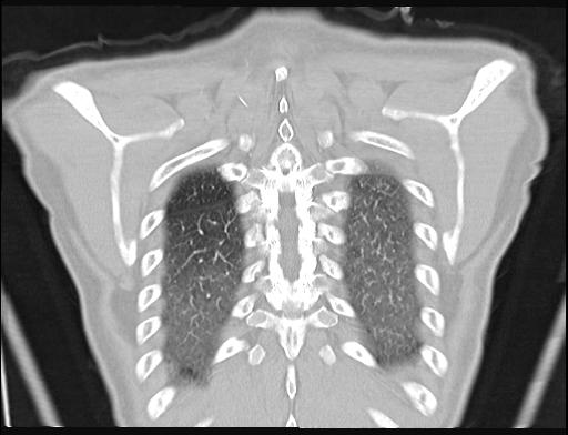 File:Addison disease (Radiopaedia 49318-54412 Coronal lung window 4).jpg