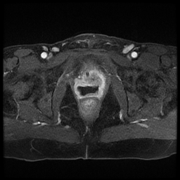File:Adenocarcinoma arising in a urethral diverticulum (Radiopaedia 12400-12657 Axial T1 C+ fat sat 6).jpg