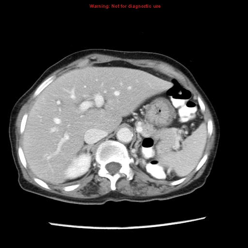 Adenocarcinoma of the colon (Radiopaedia 8191-9039 Axial liver window 18).jpg