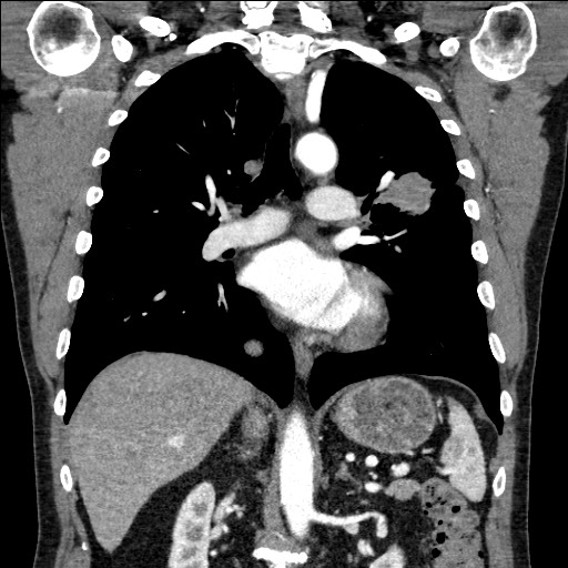 Adenocarcinoma of the lung (Radiopaedia 59871-67325 Coronal C+ arterial phase 38).jpg