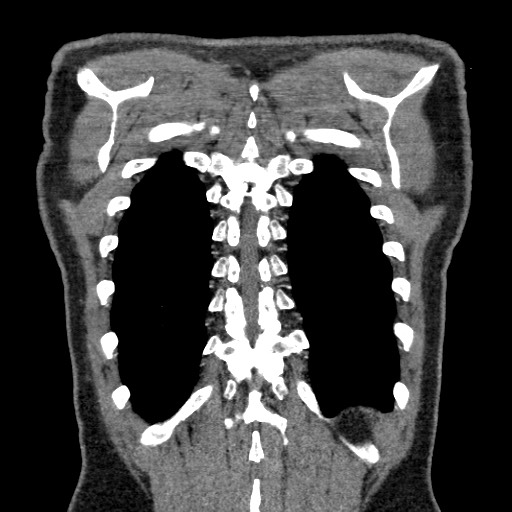 Adenocarcinoma of the lung (Radiopaedia 59871-67325 Coronal C+ arterial phase 65).jpg