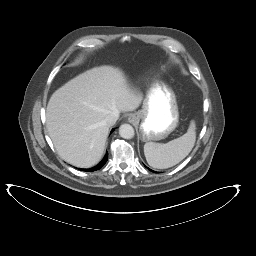 Adenocarcioma of rectum- T1 lesion (Radiopaedia 36921-38547 Axial C+ portal venous phase 16).png