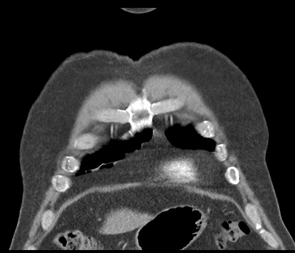 Adenocarcioma of rectum- T1 lesion (Radiopaedia 36921-38547 Coronal C+ arterial phase 13).png
