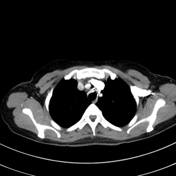 Adenocystic carcinoma of the trachea (Radiopaedia 47677-52525 Axial C+ arterial phase 36).jpg