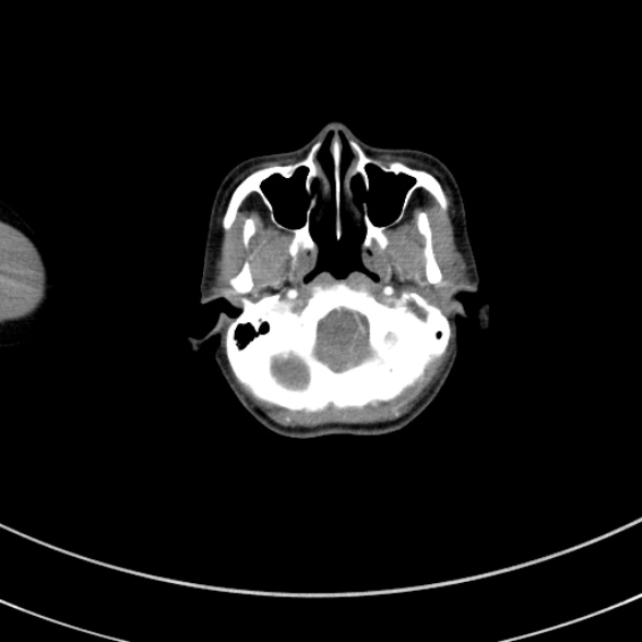Adenocystic carcinoma of the trachea (Radiopaedia 47677-52525 Axial C+ arterial phase 4).jpg