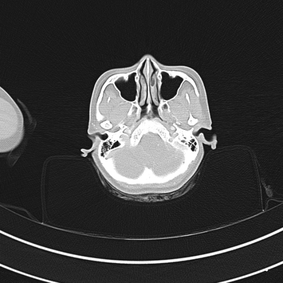 Adenocystic carcinoma of the trachea (Radiopaedia 47677-52525 Axial lung window 3).jpg