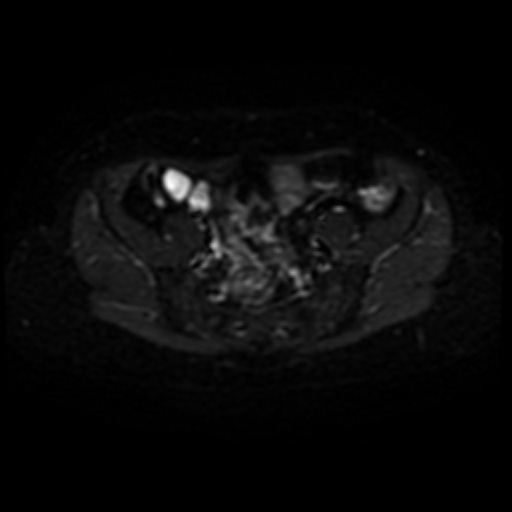 Adenoma malignum of cervix (Radiopaedia 66441-75705 Axial DWI 3).jpg