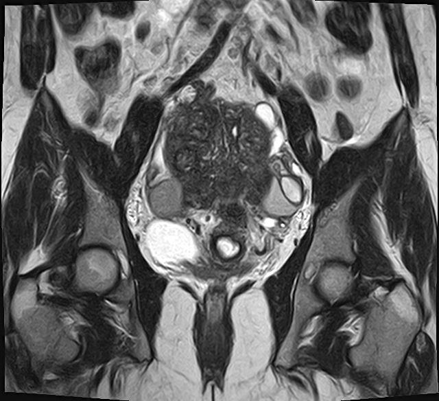 File:Adenomyosis - ovarian endometriomas (Radiopaedia 67031-76350 Coronal T2 16).jpg