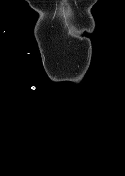 Adhesional small bowel obstruction (Radiopaedia 48397-53305 Coronal C+ portal venous phase 12).jpg