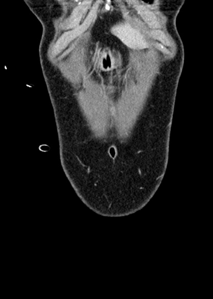 Adhesional small bowel obstruction (Radiopaedia 48397-53305 Coronal C+ portal venous phase 34).jpg