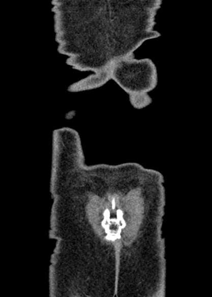 Adhesional small bowel obstruction (Radiopaedia 48397-53305 Coronal C+ portal venous phase 345).jpg
