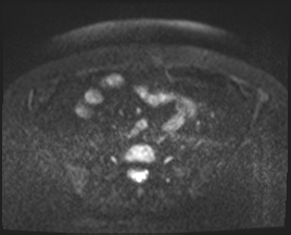 File:Adnexal multilocular cyst (O-RADS US 3. O-RADS MRI 3) (Radiopaedia 87426-103754 Axial 120).jpeg