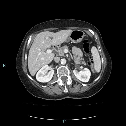 File:Adrenal collision tumor (ACT) (Radiopaedia 48462-53379 Axial C+ portal venous phase 19).jpg
