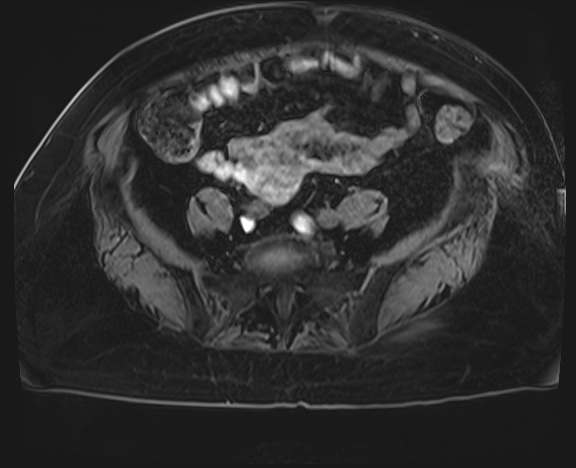 Adrenal cortical carcinoma (Radiopaedia 64017-72770 Axial T1 C+ fat sat 68).jpg