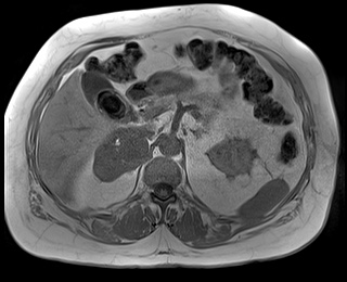 File:Adrenal cortical carcinoma (Radiopaedia 64017-72770 Axial T1 in-phase 28).jpg