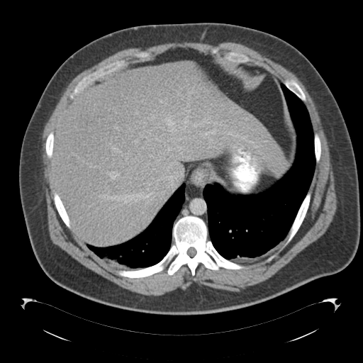 File:Adrenal cyst (Radiopaedia 45625-49776 Axial C+ portal venous phase 17).png