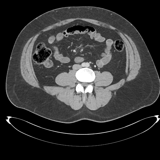 File:Adrenal cyst (Radiopaedia 45625-49778 AXIAL THICK 60 sec 65).png