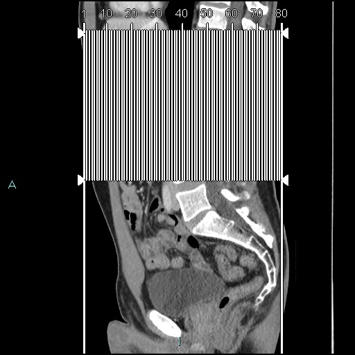 Adrenal cystic lymphangioma (Radiopaedia 83161-97534 Coronal C+ portal venous phase 1).jpg