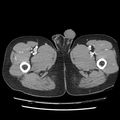 Adrenal gland trauma (Radiopaedia 81351-95078 Axial Dual bolus trauma C+ 135).jpg