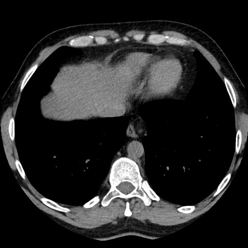 Adrenal gland trauma (Radiopaedia 81351-95079 Axial non-contrast 8).jpg