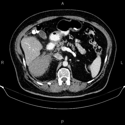 Adrenal hemorrhage (Radiopaedia 62622-70916 Axial C+ portal venous phase 65).jpg
