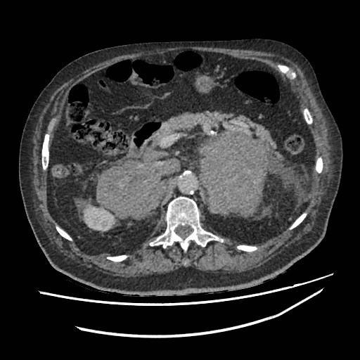 Adrenal lymphoma (Radiopaedia 84145-99415 Axial C+ portal venous phase 39).jpg