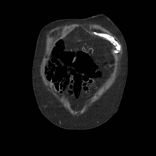 Adrenal lymphoma (Radiopaedia 84145-99415 Coronal C+ portal venous phase 1).jpg