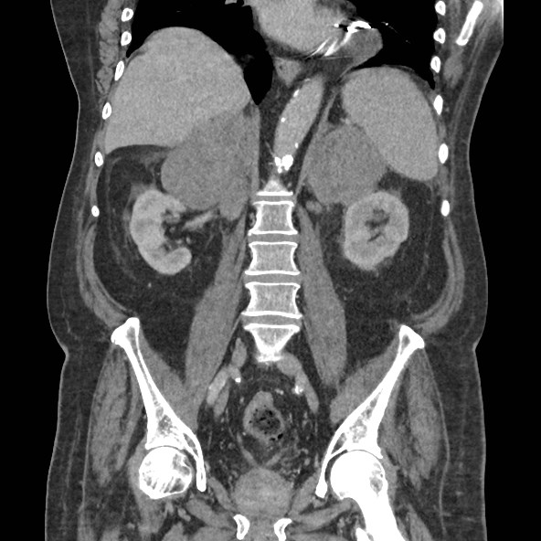 Adrenal lymphoma (Radiopaedia 84145-99415 Coronal C+ portal venous phase 54).jpg
