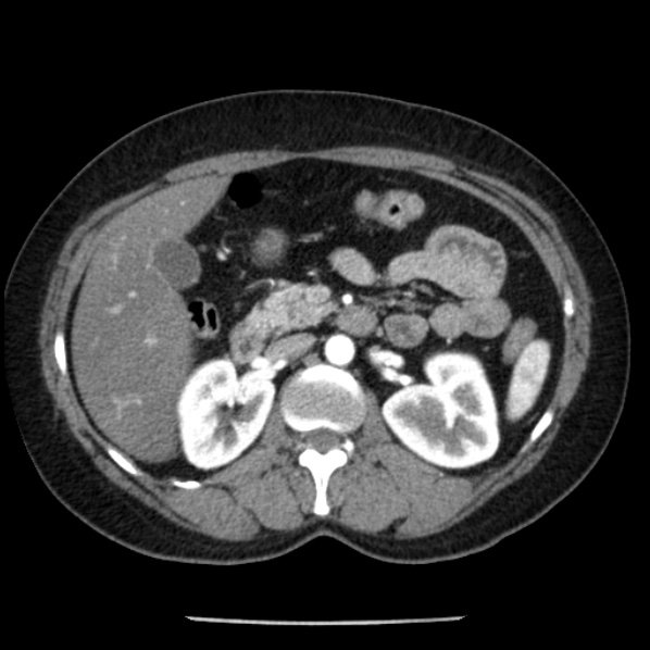 Adrenal myelolipoma (Radiopaedia 43401-46759 Axial C+ arterial phase 39).jpg