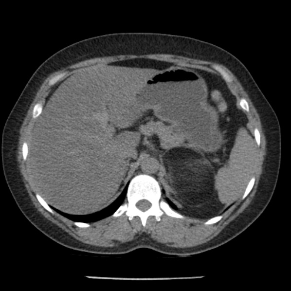 Adrenal myelolipoma (Radiopaedia 43401-46759 Axial non-contrast 22).jpg