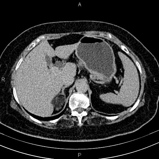 Adrenal myelolipoma (Radiopaedia 82742-96986 Axial renal excretory phase 31).jpg